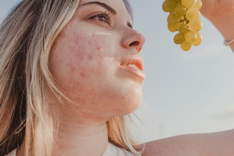 Are Grapes Good for Acne